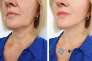 Double chin before and after Hi-Fu treatment 4 Book your double chin treatment Greater Manchester today! We are here to help!