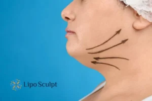 Double chin before and after Hi-Fu treatment 3 Boost your confidence with a Double chin treatment Greater Manchester