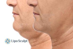 Double chin before and after Hi-Fu treatment 2 Double chin treatment Greater Manchester from Lipo Sculpt - feel more confident today!