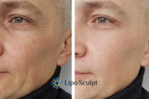 How to Fight Aging Symptoms 3 Fight Aging Symptoms Greater Manchester With HIFU and Morpheus8 Today!