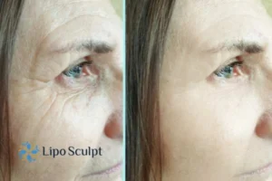 How to Fight Aging Symptoms 2 Do you want to Fight Aging Symptoms Greater Manchester? Contact Lipo Sculpt today!