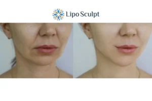 Explaining Total Skin Tightening Treatment And What It Can Do For You 2 Do you want to boost your self confidence? Give Morpheus8 Greater Manchester a try today!