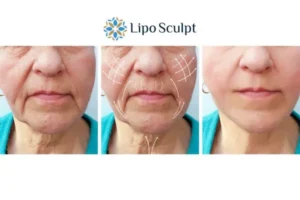 Explaining Total Skin Tightening Treatment And What It Can Do For You 3 Boost your confidence with Morpheus8 Greater Manchester call our team today!