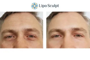 Explaining Total Skin Tightening Treatment And What It Can Do For You 6 Morpheus8 Greater Manchester book in today to find out more!
