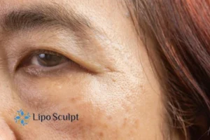 Cryopen: The Revolutionary Treatment for Age Spots Unveiled 2 Are age spots Greater Manchester giving you low self esteem? Contact us today!