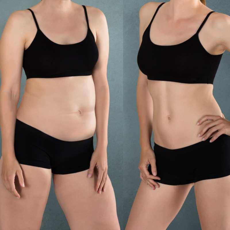 Does Fat Freezing at Home Work? DIY Devices vs Professional Cryolipolysis 2 before and after Cryolipolysis Greater Manchester