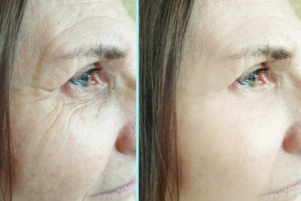 Why Do People Choose HIFU for a Non-Surgical Facelift? 4 How long can HIFU results last Greater Manchester?