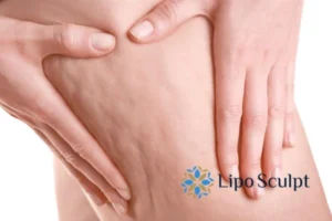 CoolSculpting for Legs: The Innovative Approach to Redefining Your Legs 5 Start your journey today book your coolsculpting treatment Greater Manchester online today!