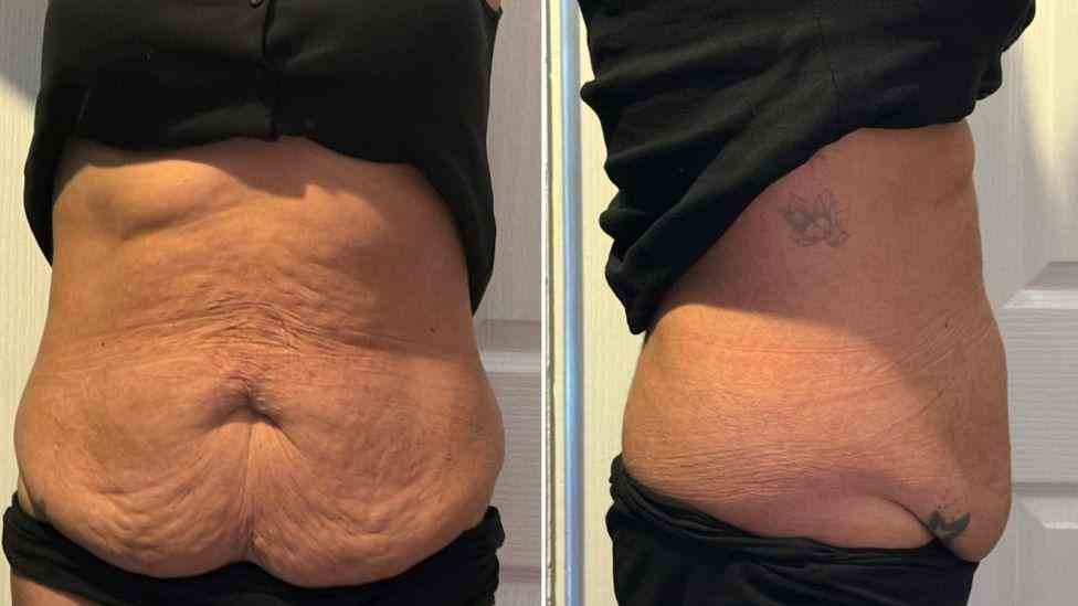 Lost the Weight but Not the Loose Skin? What You Should Know 1 Is It Definitely Loose Skin Greater Manchester?